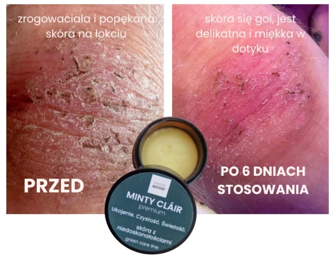 GREEN MOON® MINTY CLÁIR premium – maść pielęgnacyjna do skóry problematycznej i z niedoskonałościami